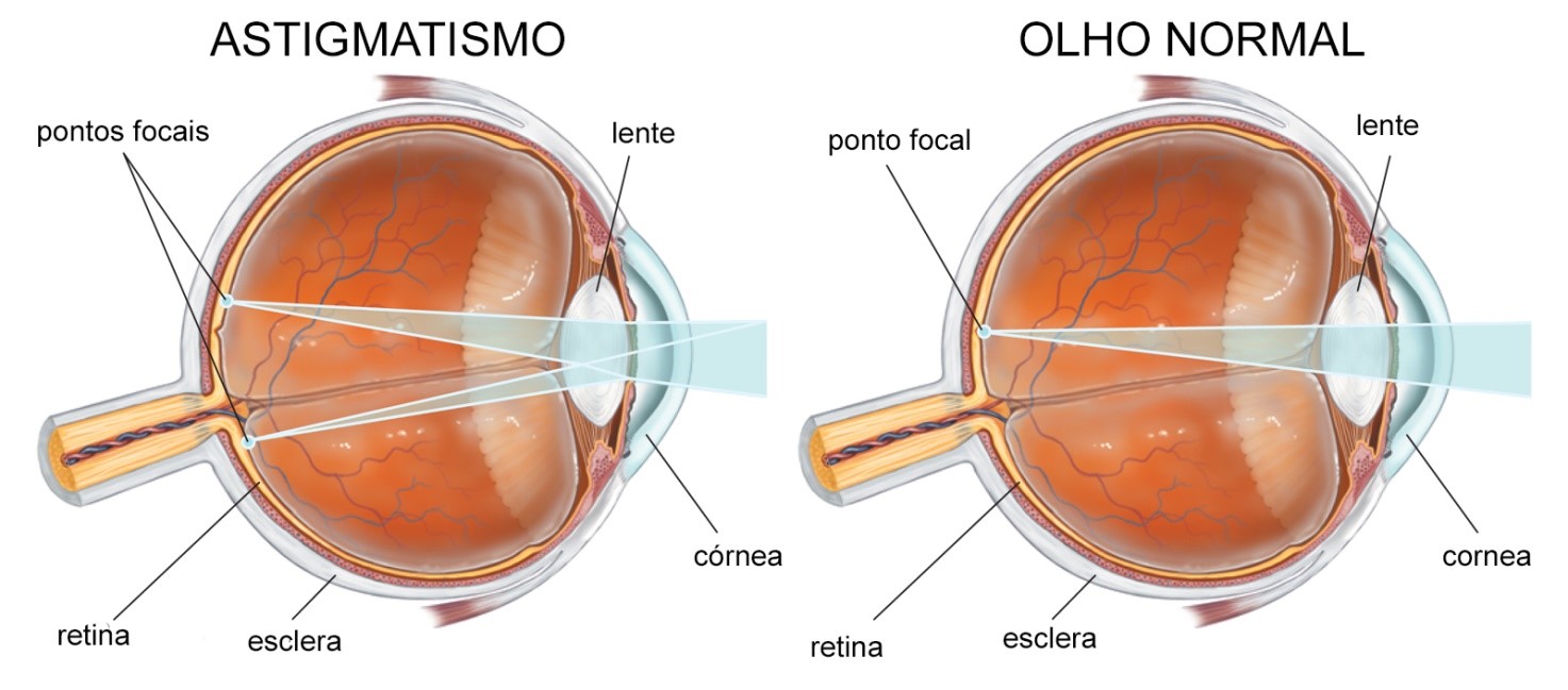 astigmatismo-ghisi-oftalmocl-nica