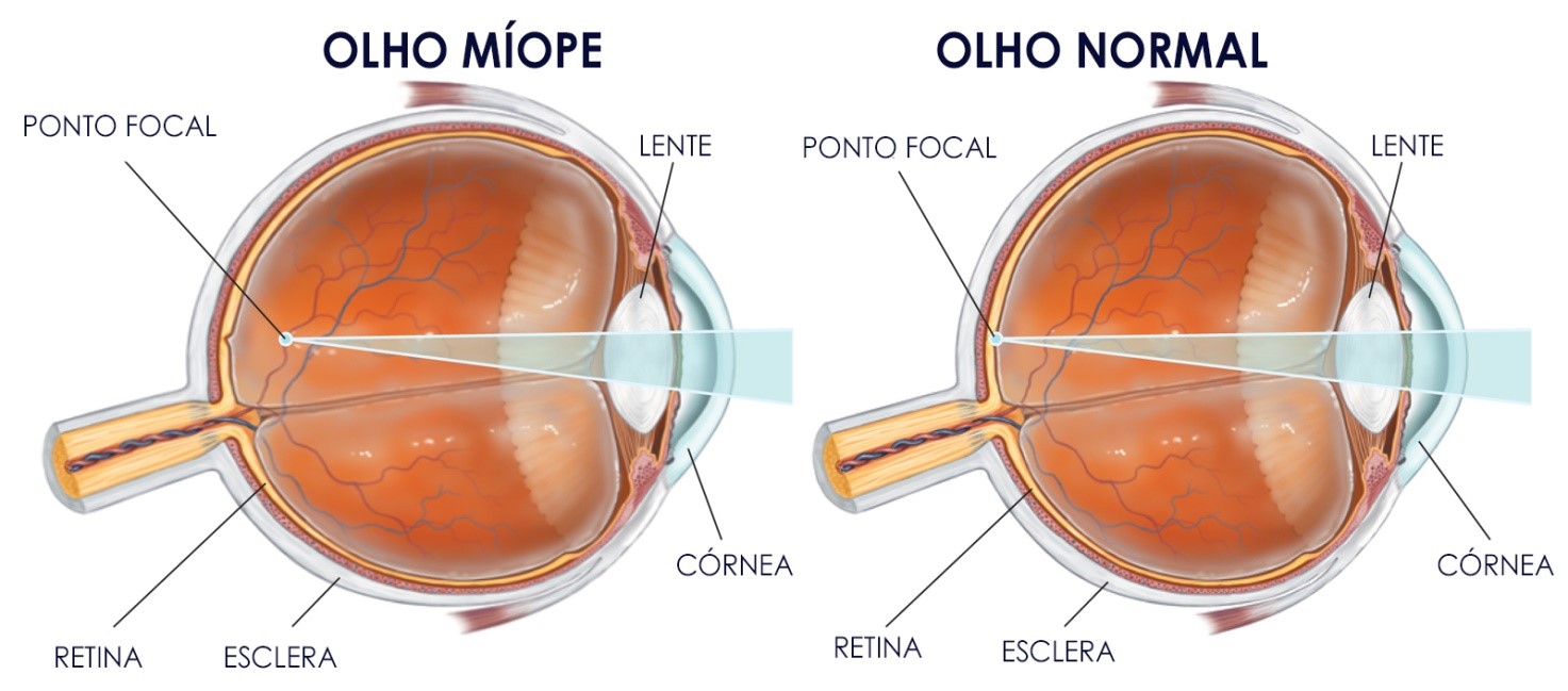 miopia ghisi oftalmoclínica